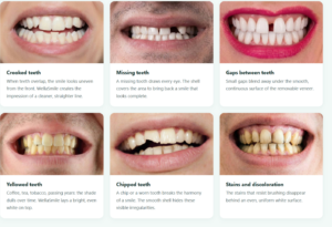 WellaSmile Veneers Review 2026: Safe? Do They Really Work?